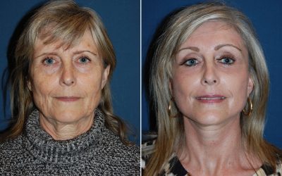 Charlotte’s best eyelift surgeon explains all to know about eyelid surgery