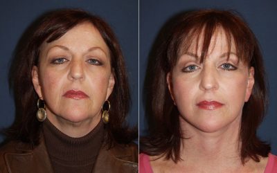 Charlotte’s best facelift specialist talks about aging neck and jowls