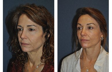 Charlotte’s Best Facial Plastic Surgeon discusses factors related to facelifts