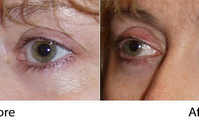 Charlotte’s Soof Lift Blepharoplasty Expert – Eye Rejuvenation