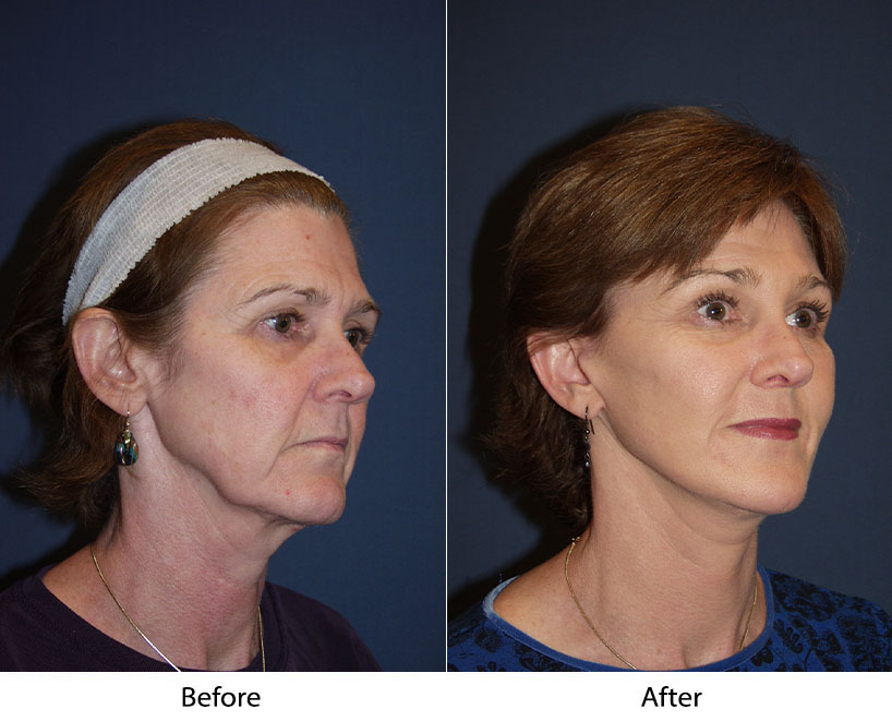 Facelift surgeon in Charlotte NC To Correct Signs of Aging