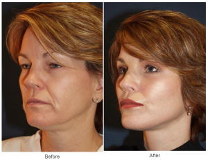 Facelift Experts in Charlotte NC: Mastering Makeup After Surgery