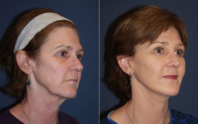 Facelift Surgeon in Charlotte NC: Tips for Longevity