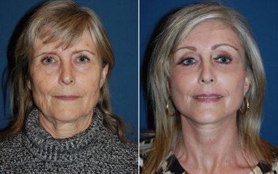 Charlotte’s Best Eyelift Surgeon to Improve Hooded Eyes