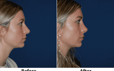 Charlotte’s Best Facial Plastic Surgeon: Cosmetic vs Reconstructive Surgery