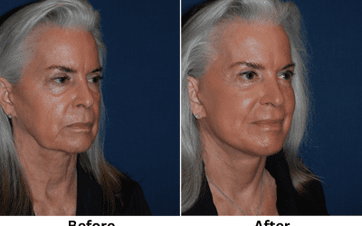 Segmental Endoscopic Brow Lift Effects and Benefits in Charlotte