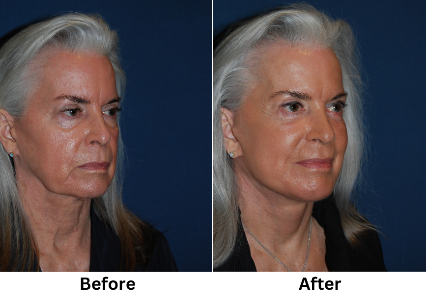 Segmental endoscopic brow lift