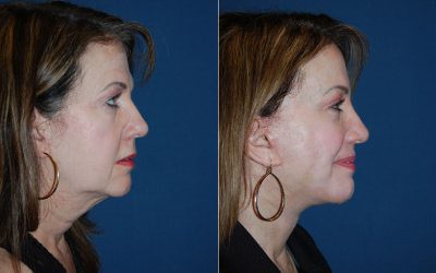 Charlotte’s Top Soof Lift Blepharoplasty Surgeon: Brow Lift vs Blepharoplasty