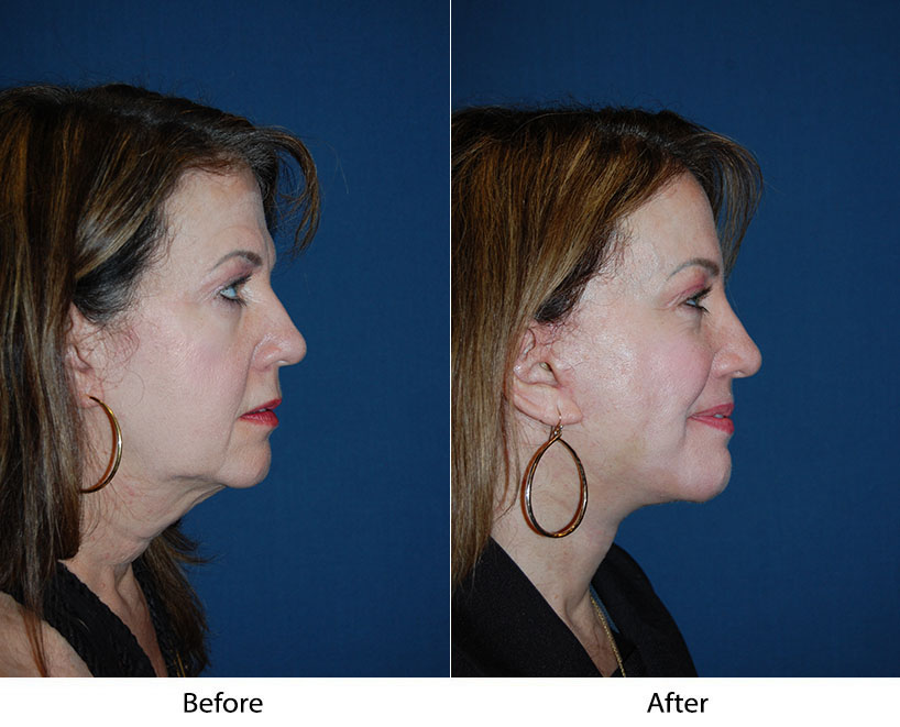 Soof Lift Blepharoplasty