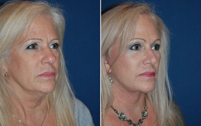 Charlotte’s segmental endoscopic brow lift surgeon for youth