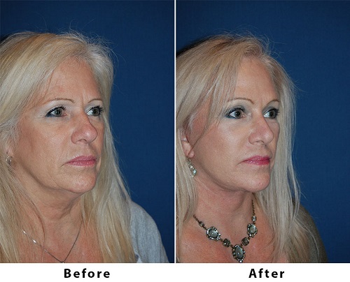 Segmental endoscopic brow lift