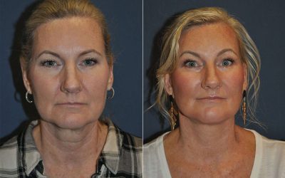 SOOF Lift Blepharoplasty in Charlotte NC: Impact of Prosthetic Eye