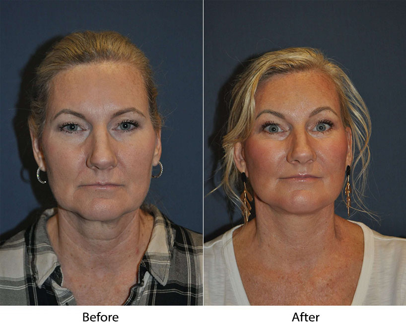 Soof Lift Blepharoplasty