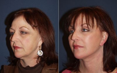 Facelift surgeon discusses men’s trends in Charlotte NC